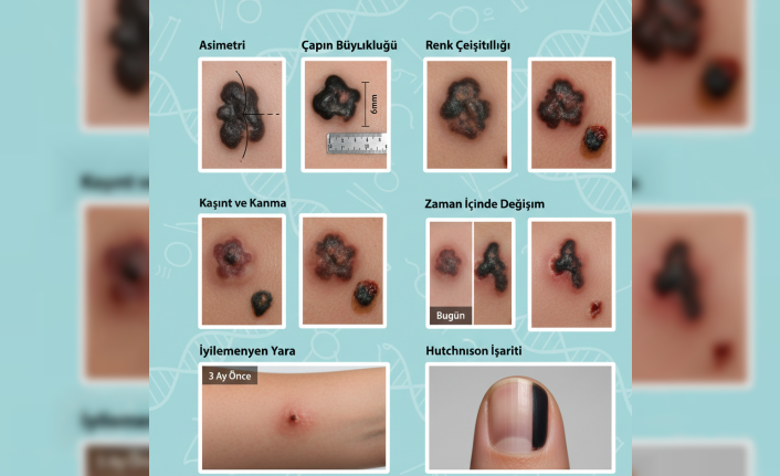 Teninizdeki İzler: Masum Benler mi, Cilt Kanseri Alarmı mı?