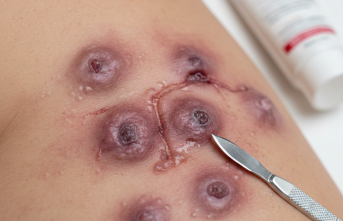 Cilt Altındaki Gizli Tehlike: Hidradenitis Süpürativa'da Son Gelişmeler ve Bilinmesi Gerekenler