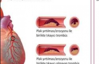 Gözden Kaçan Kalp Hastalığı: Mikrovasküler Anjina Nedir ve Kadınlarda Neden Daha Sık Görülür?