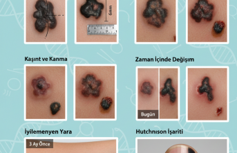Teninizdeki İzler: Masum Benler mi, Cilt Kanseri Alarmı mı?