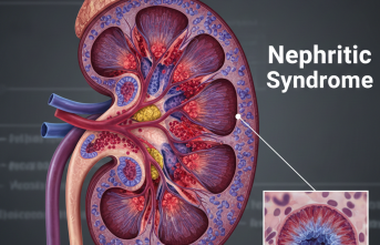 Böbreklerdeki Sessiz Tehlike: Nefritik Sendrom