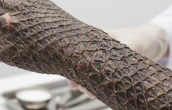 Cildin Bitmeyen Nöbeti: İktiyozis ile Yaşamak