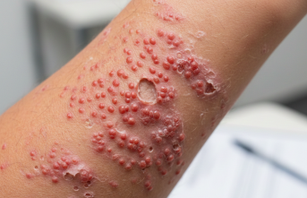 Cildin Glutenle İmtihanı: Dermatit Herpetiformis