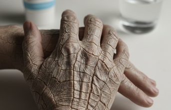 Ciltteki Sessiz Çatlaklar: İktiyozis Vulgaris