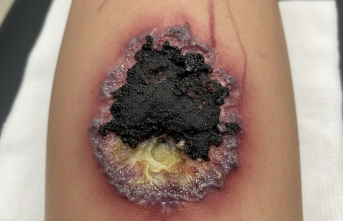 : Derinleşen Tehlike: Basit Bir Yaranın Ardındaki Ektima Şüphesi