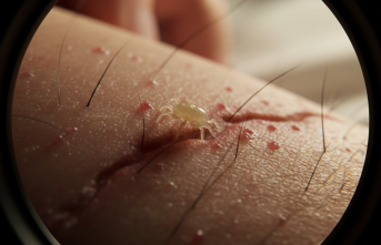 Geceleri Artan Kaşıntı Kabusu: Uyuzla Mücadele