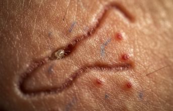 Görünmez Misafirlerin Gece Mesaisi: Uyuz Artık Her Yerde mi?