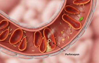 Karnınızdaki Sessiz Alarm: Divertikülit