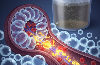 Vücut Neden Su Toplar? Nefrotik Sendromu Anlamak