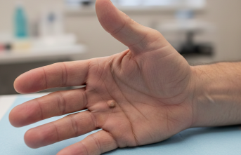 Avuç İçindeki Gizli Tehlike: Dupuytren Kontraktürü