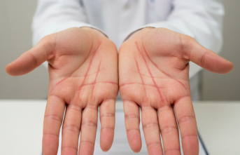 Avuç İçindeki Sessiz İşaret: Çizgili Palmar Eritem