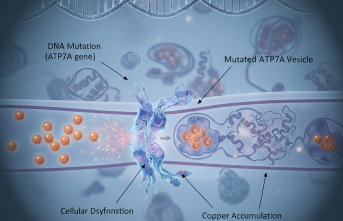 Bakır Eksikliği Bebeklerde Kritik Risk Taşıyor: Menkes Hastalığı