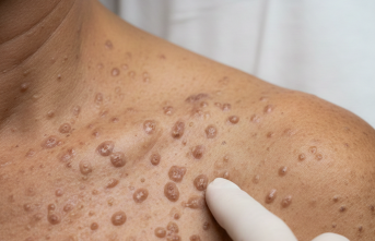 Ciltte Geçmeyen Pütürler: Darier Hastalığıyla Yaşamak