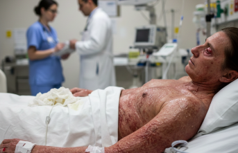 Deride Ciddi Hasar: Toksik Epidermal Nekroliz Vakaları Mercek Altında