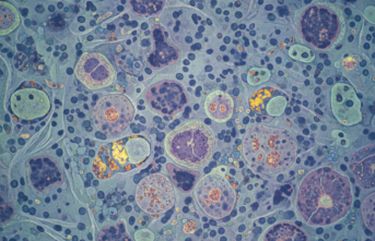 Güneş Işığına Hassas Hayatlar: Kseroderma Pigmentosum