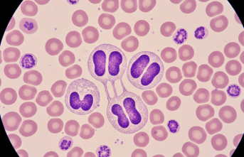 Kan Tetkiklerinde Şaşırtan Bulgular: Pelger Huet Anomalisi