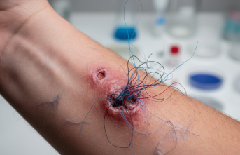 Morgellons Sendromu: Deri Altında Gizemli Lifler