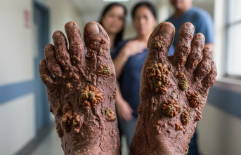 Nadir Görülen Genetik Hastalık: Epidermodysplasia Verruciformis