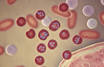 Nadir Görülen Glanzmann Trombastenisi İçin Erken Tanı Uyarısı