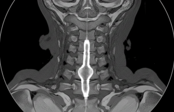 Omuriliğin Sessiz Misafiri: Siringomiyeli