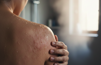 Suyla Temas Kabusa Dönüşüyor: Aquagenic Urticaria Nedir?