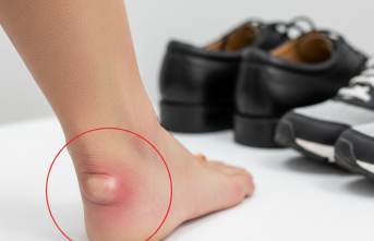 Topukta Ağrılı Çıkıntı: Haglund Deformitesi Nedir?