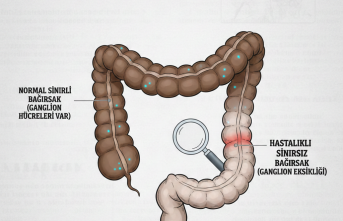 Yenidoğanlarda Bağırsak Tıkanıklığı Riski: Hirschsprung Belirtilerine Dikkat