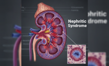 Böbreklerdeki Sessiz Tehlike: Nefritik Sendrom