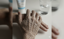 Ciltteki Sessiz Çatlaklar: İktiyozis Vulgaris