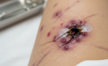 Derinin Altındaki Sessiz Ağrı: HS ile Yaşamak