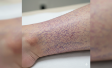 Ciltteki Mor Dantel Görünümü Mercek Altında