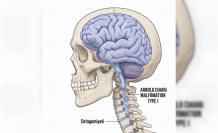 Ensedeki Gizemli Ağrının Adı: Chiari