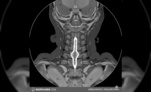Omuriliğin Sessiz Misafiri: Siringomiyeli