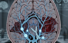 Beynin Sessiz Düşmanı: Serebral Amiloid Anjiyopati'de (SAA) Yeni Dönem