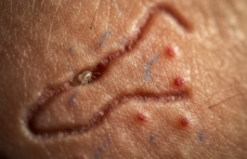 Görünmez Misafirlerin Gece Mesaisi: Uyuz Artık Her Yerde mi?