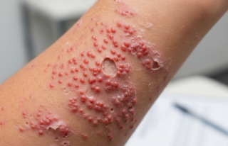 Cildin Glutenle İmtihanı: Dermatit Herpetiformis