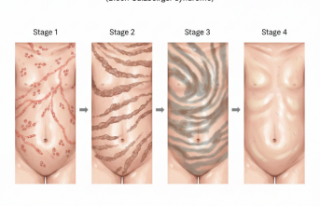 Ciltteki Garip İzlerin Gizemi: Incontinentia Pigmenti