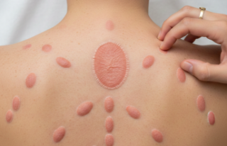 Ciltteki Gizemli Misafir: Pityriasis Rosea