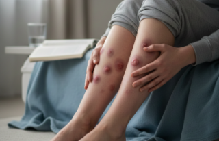 Bacaklardaki ağrılı şişliklere dikkat: Eritema...