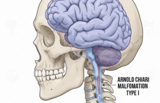Ensedeki Gizemli Ağrının Adı: Chiari