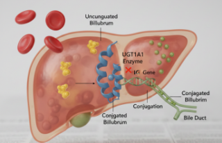 Gilbert Sendromu Genetik mi? Belirtileri Nelerdir?