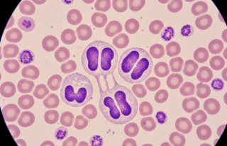 Kan Tetkiklerinde Şaşırtan Bulgular: Pelger Huet...