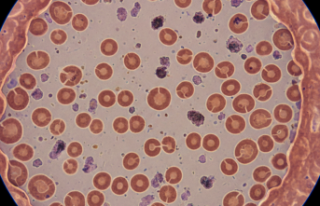 Kanın Rengi Solarken: Talasemi ile Yaşam Mücadelesi