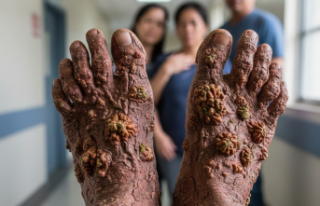 Nadir Görülen Genetik Hastalık: Epidermodysplasia...