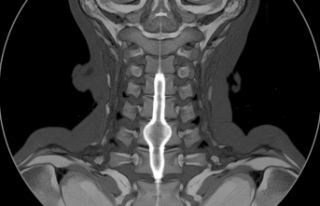 Omuriliğin Sessiz Misafiri: Siringomiyeli