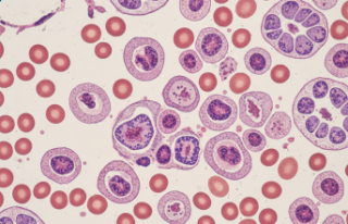 Sessizce İlerleyen Bir Mücadele: Diamond Blackfan...