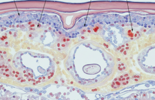 Tenin Kırılgan Hikayesi: Epidermolizis Bülloza