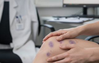 Trombositopenik Purpura Vakalarında Artış: Belirtilere...