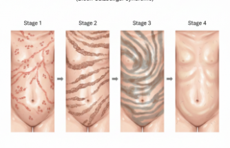 Ciltteki Garip İzlerin Gizemi: Incontinentia Pigmenti