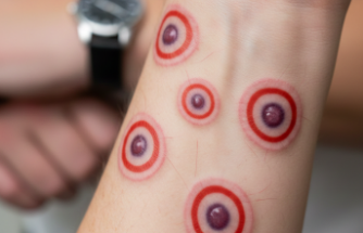 Vücutta Aniden Beliren Hedef Tahtaları: Eritema Multiforme